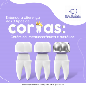 Entenda a diferença dos 3 tipos de coroas: Cerâmica, metalocerâmica e
